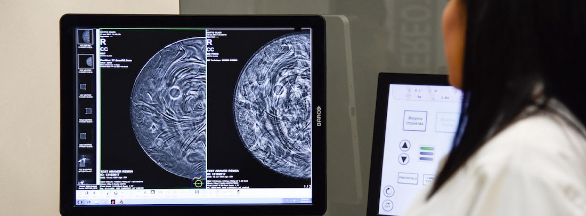 Estudio revela que sufrir diabetes aumenta 23% el riesgo de padecer cáncer de mama