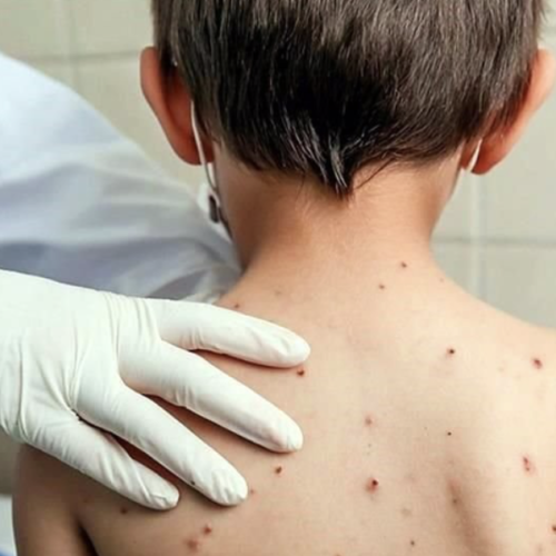 Salud advierte riesgo de brote de sarampión en Oaxaca por baja cobertura de vacunación